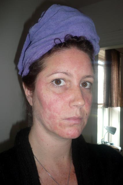 The writer Melanie Vollick's rash on her face, a reaction to hair dye with the chemical PPD in it. Photo courtesy of Melanie Vollick